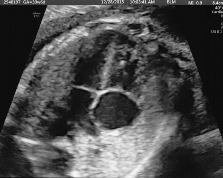 Pregnancy: Fetal Heart with closed valves