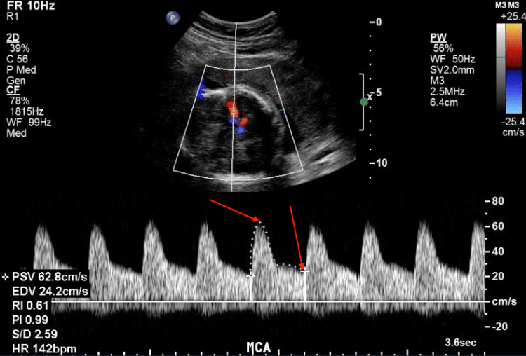 Pregnancy: Umbilical Doppler Waveform