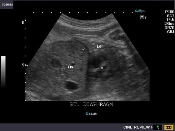 Pregnancy: Fetal diaphragm
