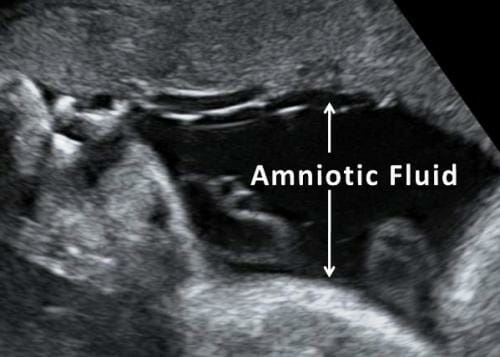 Pregnancy: Amniotic Fluid