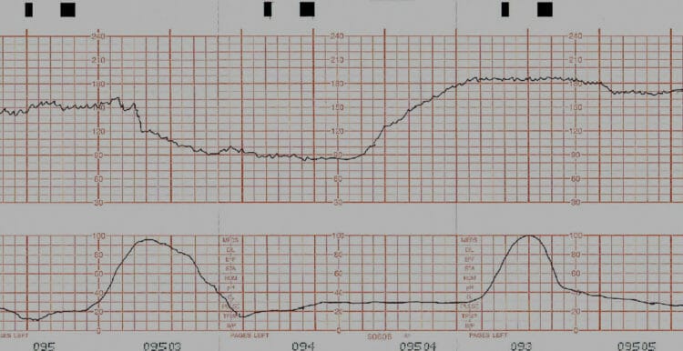 Pregnancy: Prolonged deceleration