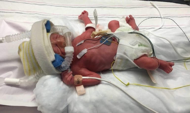 The journey of our preemie in the NICU of Northside Hospital
