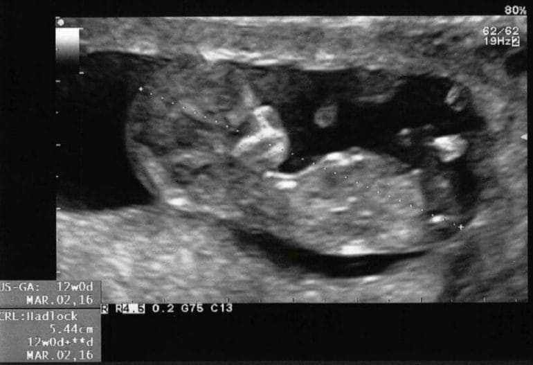 An ultrasound of our son Lucas at 12 weeks.