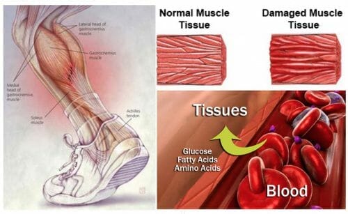 Damaged muscle tissue