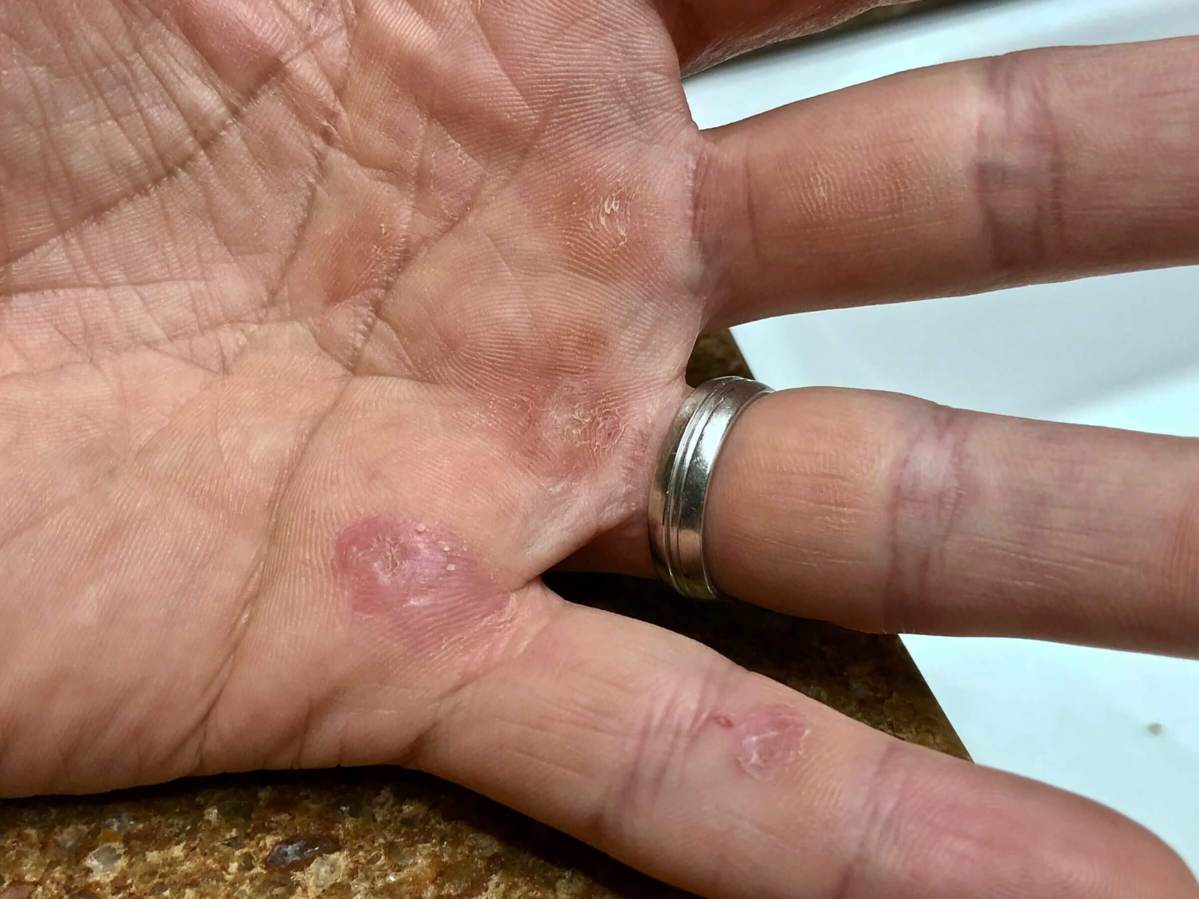 Calluses and healed skin tears