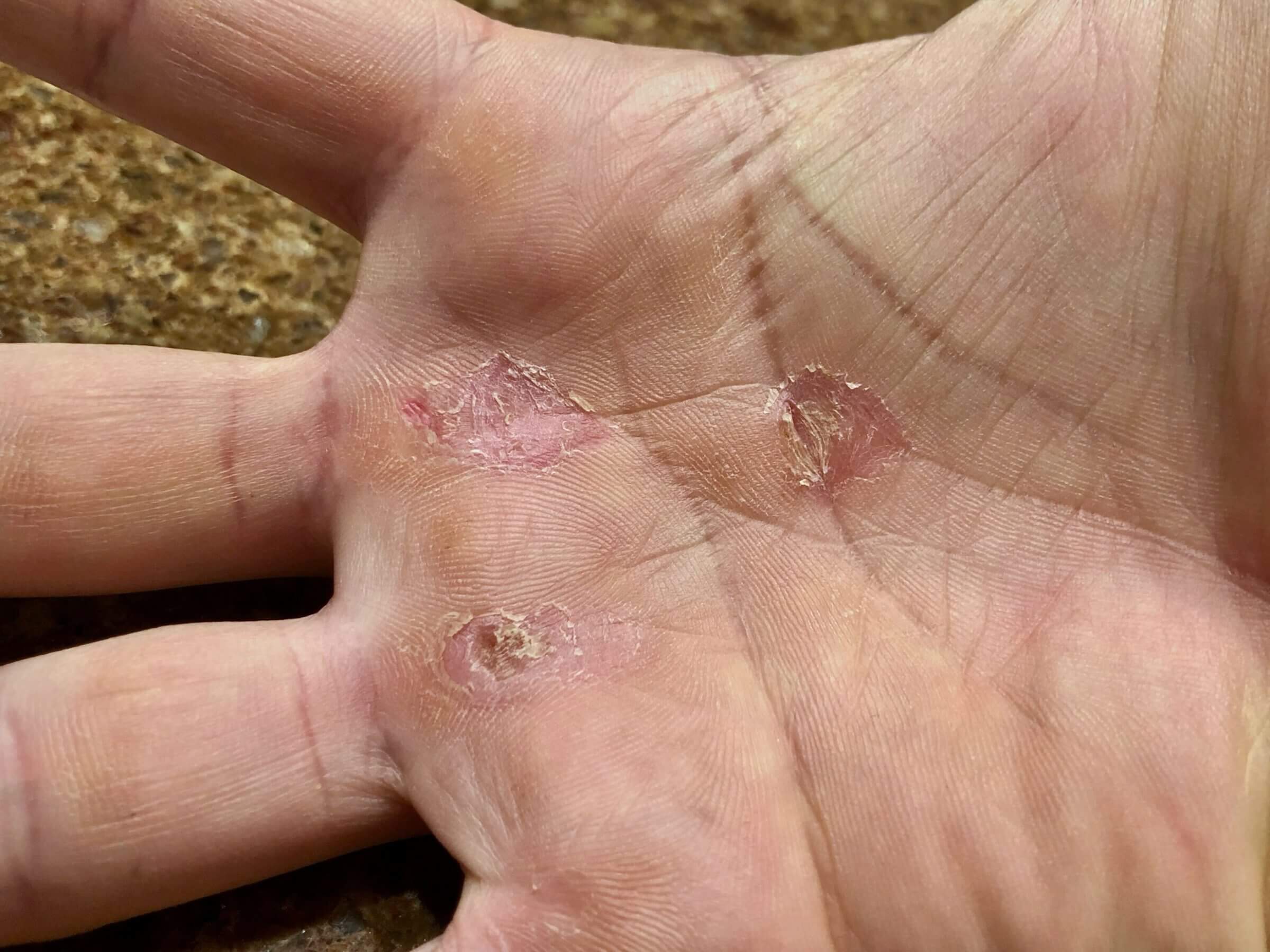 Calluses and healed skin tears