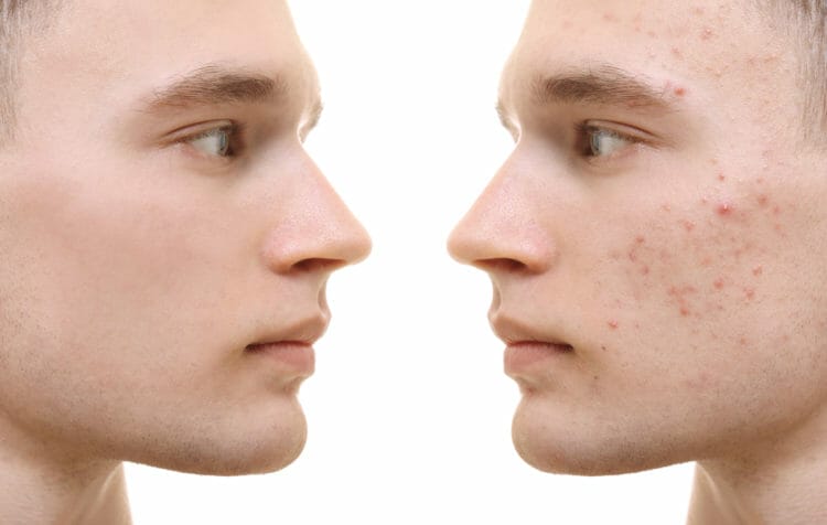 Keto can reduce or treat acne