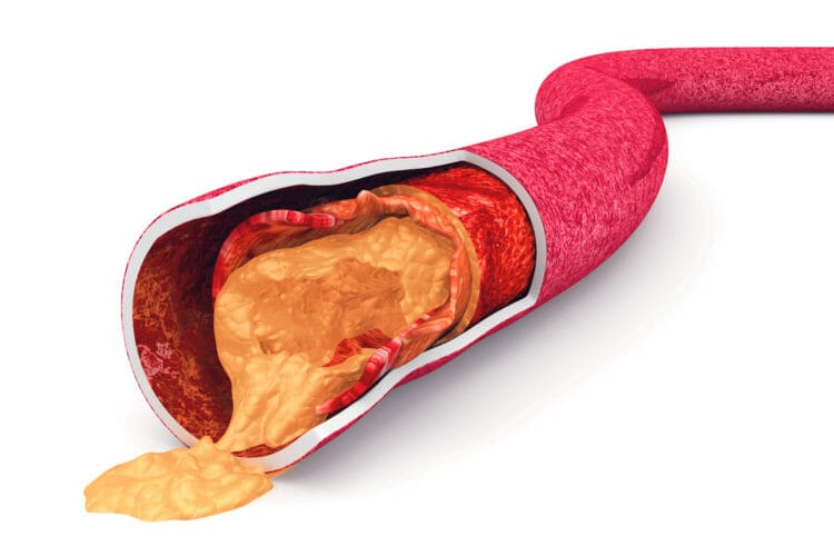 Saturated fat and dietary cholesterol do not clog your arteries