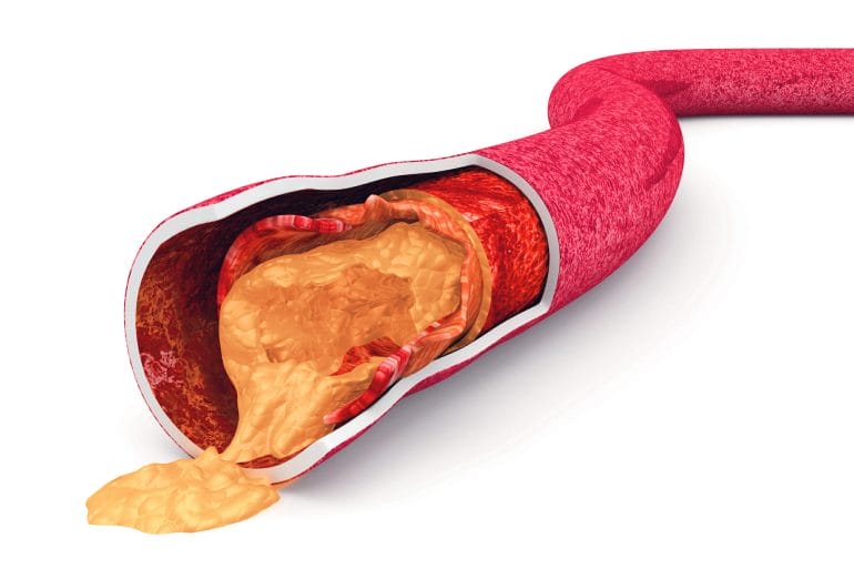 Clogged artery