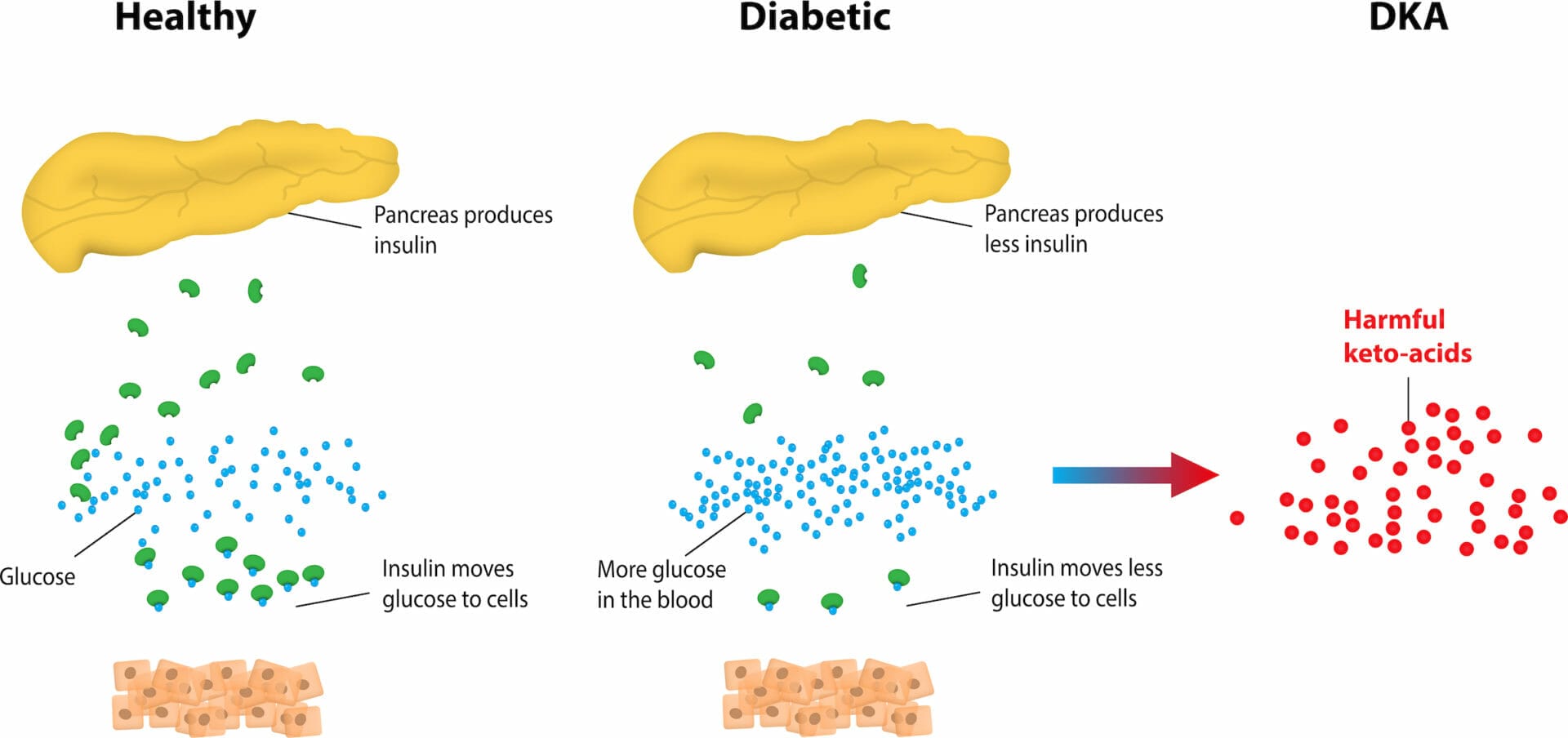 Diabetic ketoacidosis