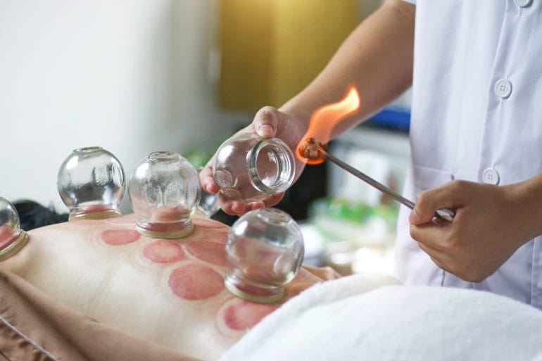 Cupping therapy