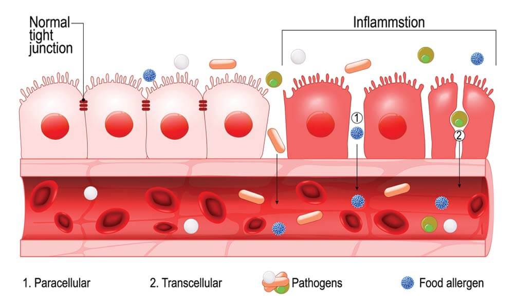 A diagram showing the process of leaky gut.