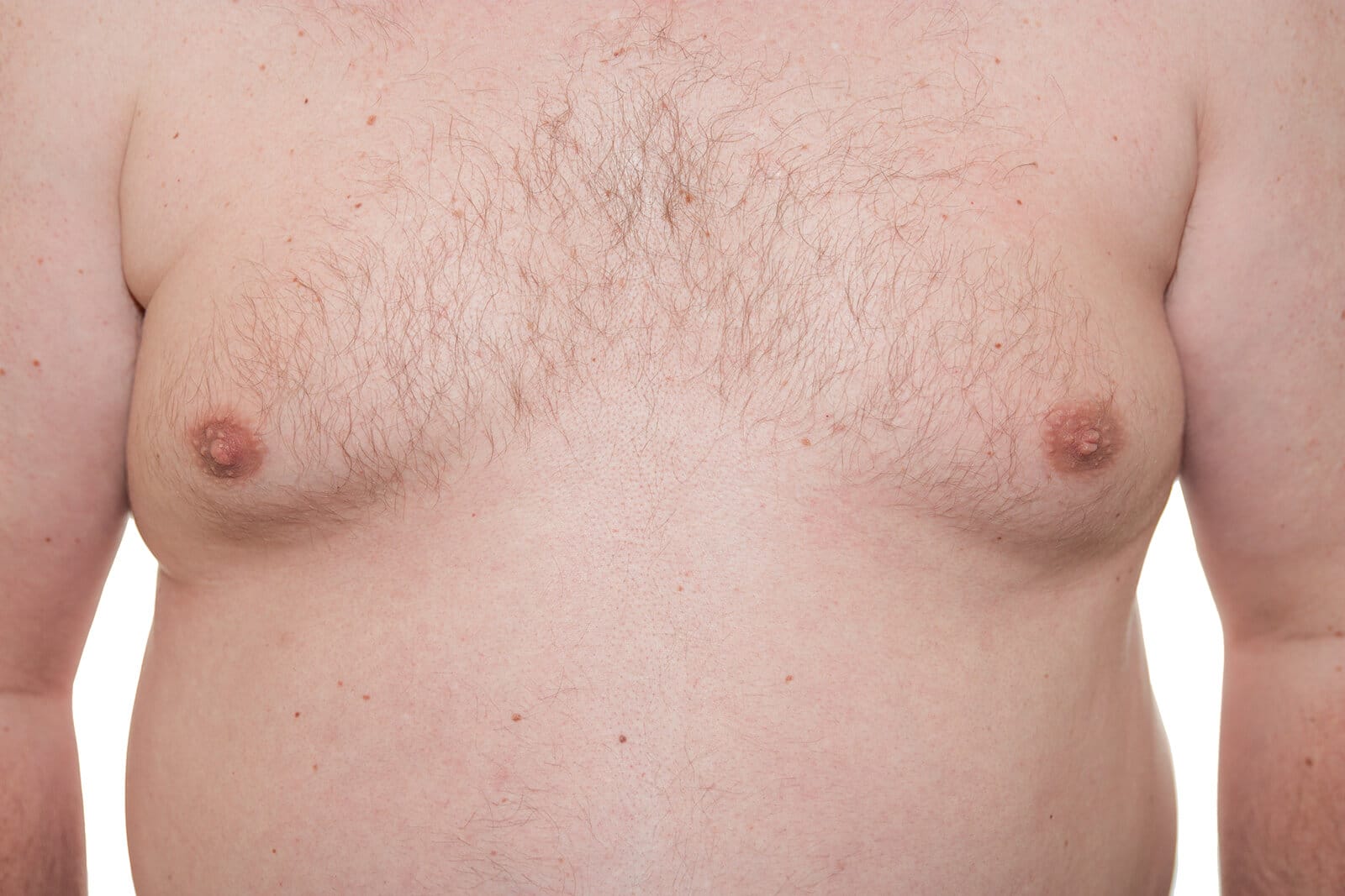 A photo of estrogen-induced man boobs.