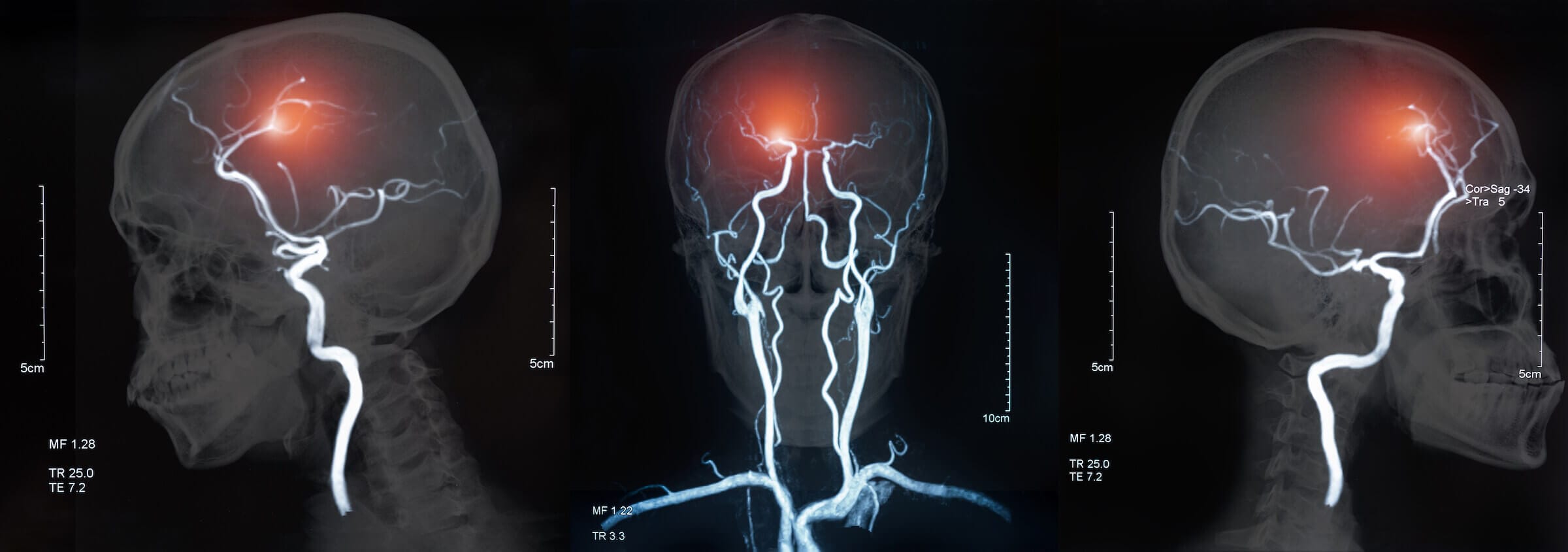 A stroke occurs when the blood supply to part of your brain is interrupted or reduced, preventing brain tissue from getting oxygen and nutrients.
