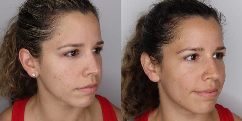 My wife Kathy before and after using red light therapy.