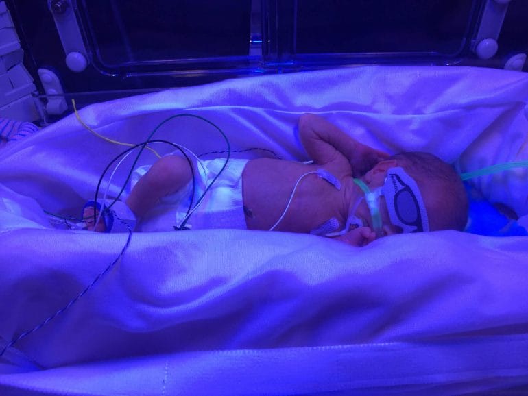 Our baby boy was treated with blue light when he was born prematurely and spent two months in the NICU.