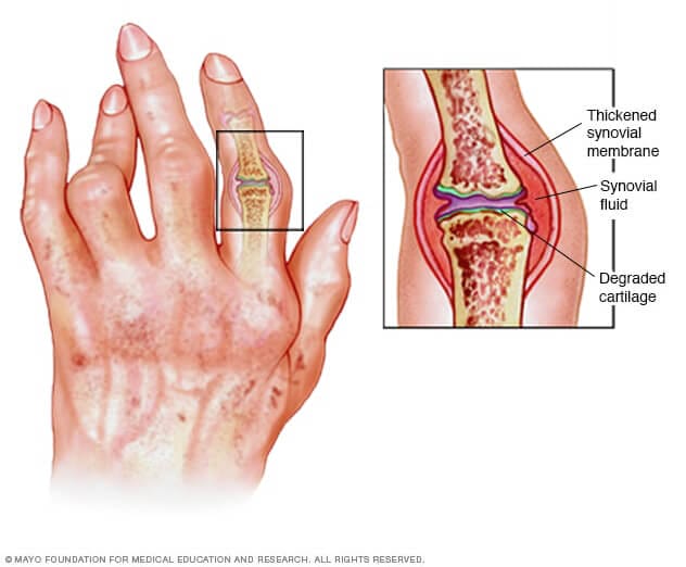 Rheumatoid arthritis is an inflammatory disease caused by lifestyle choices.