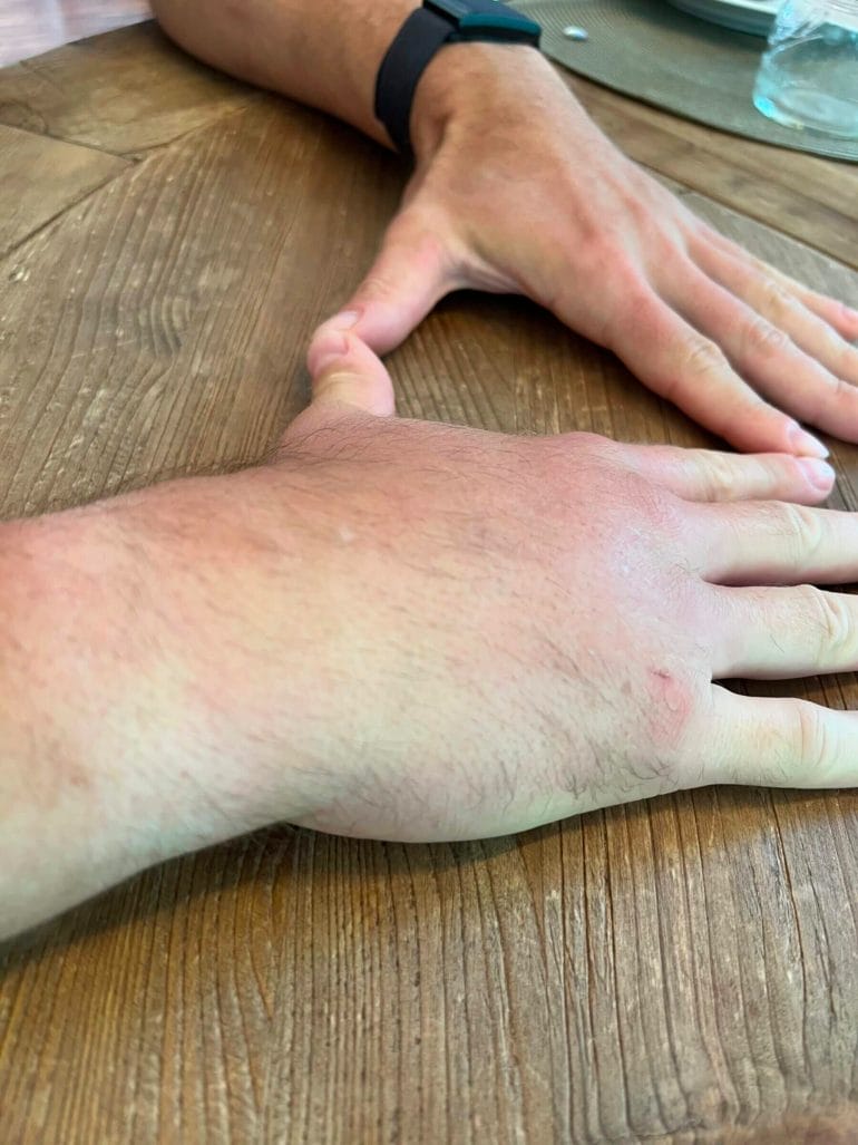 Swollen hand after bee sting