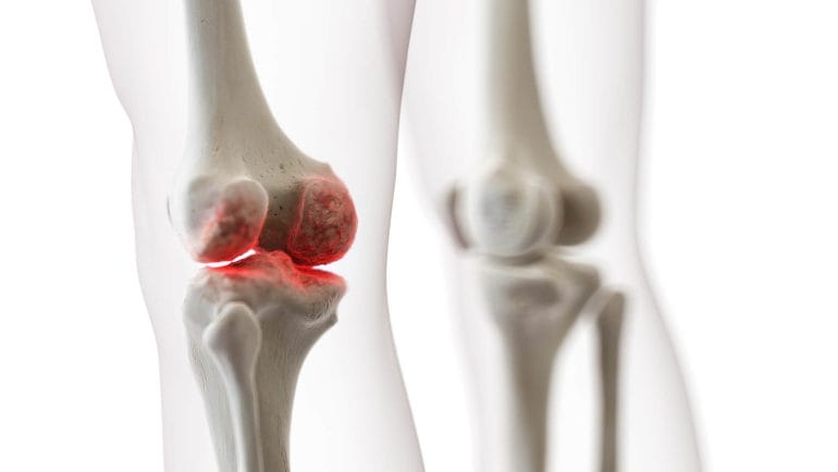 Osteoarthritis causes the erosion of cartilage tissue at the ends of the bones.