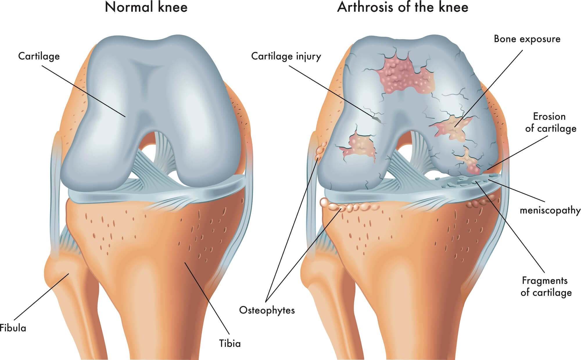 PBM can help repair and regrow cartilage tissue.