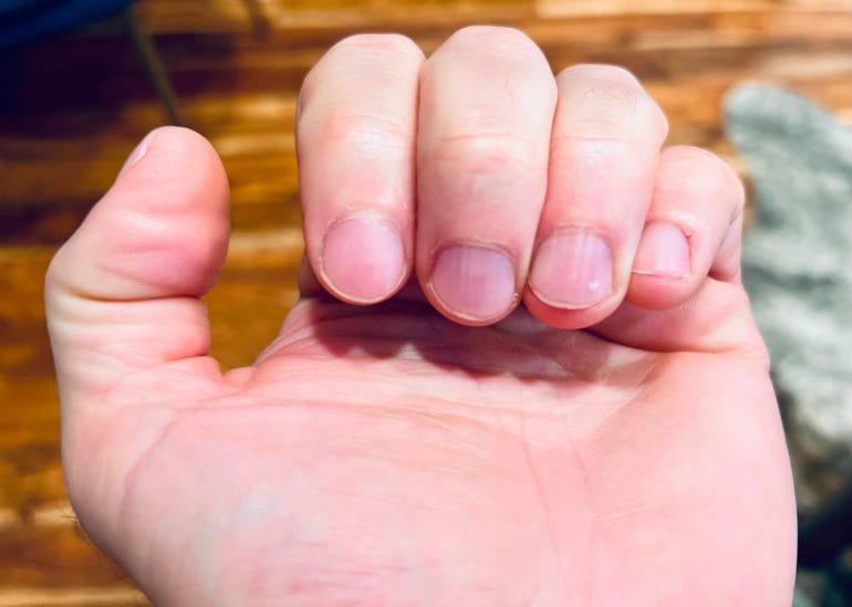Michael Kummer's finger nails.