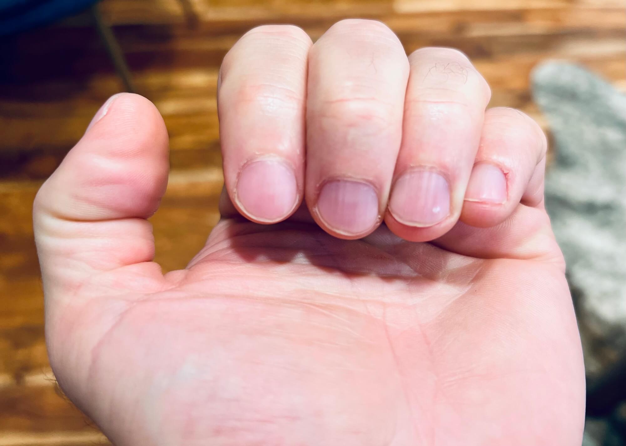 Michael Kummer's finger nails.