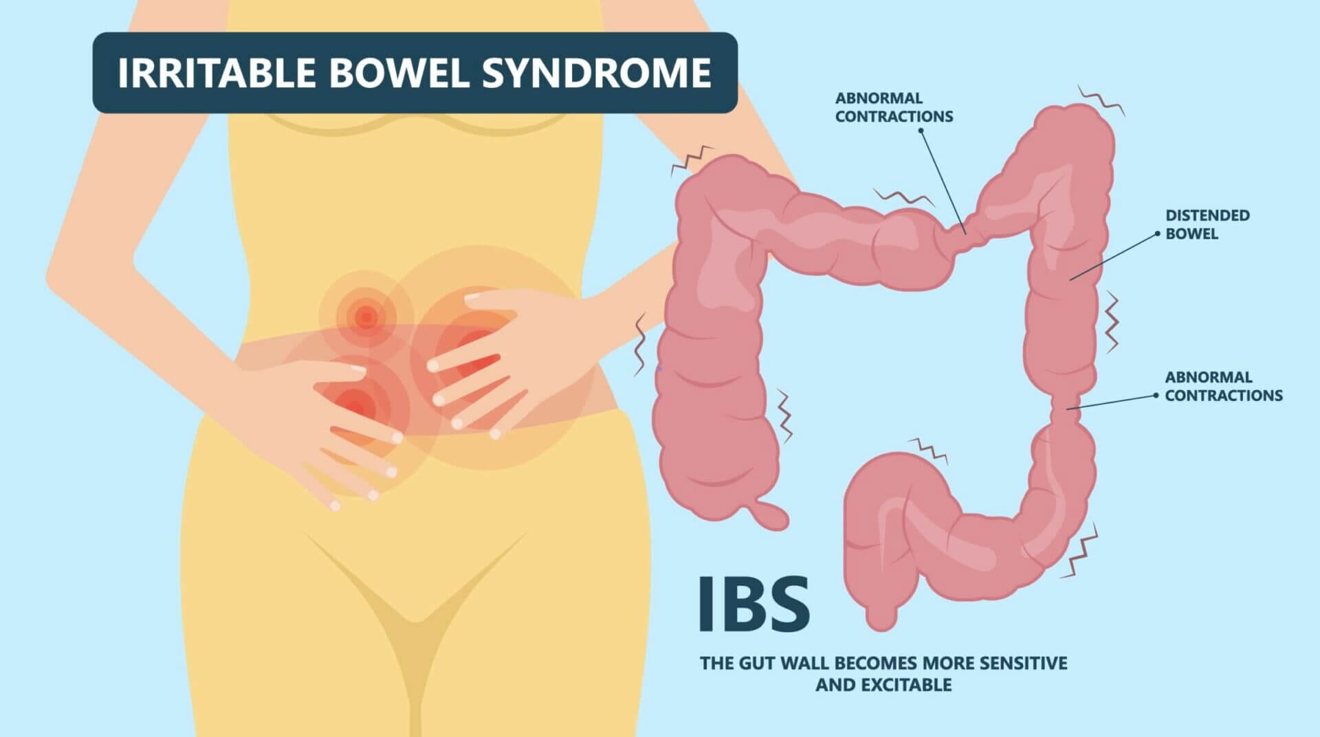 Irritable bowel syndrome (IBS)