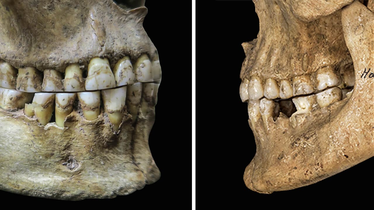 An ancient woman from Romania shows an edge-to-edge bite (left). A Bronze Age man from Austria had a slight overbite (right).