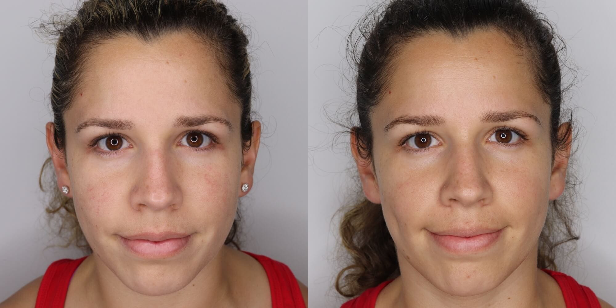My wife's skin before (left) and after (right) using red light therapy for a few weeks.