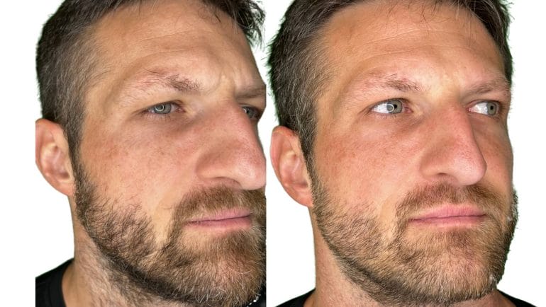 The image above shows a reduction of the dark age spots on my check after having used One Skin on and off for 15 weeks.