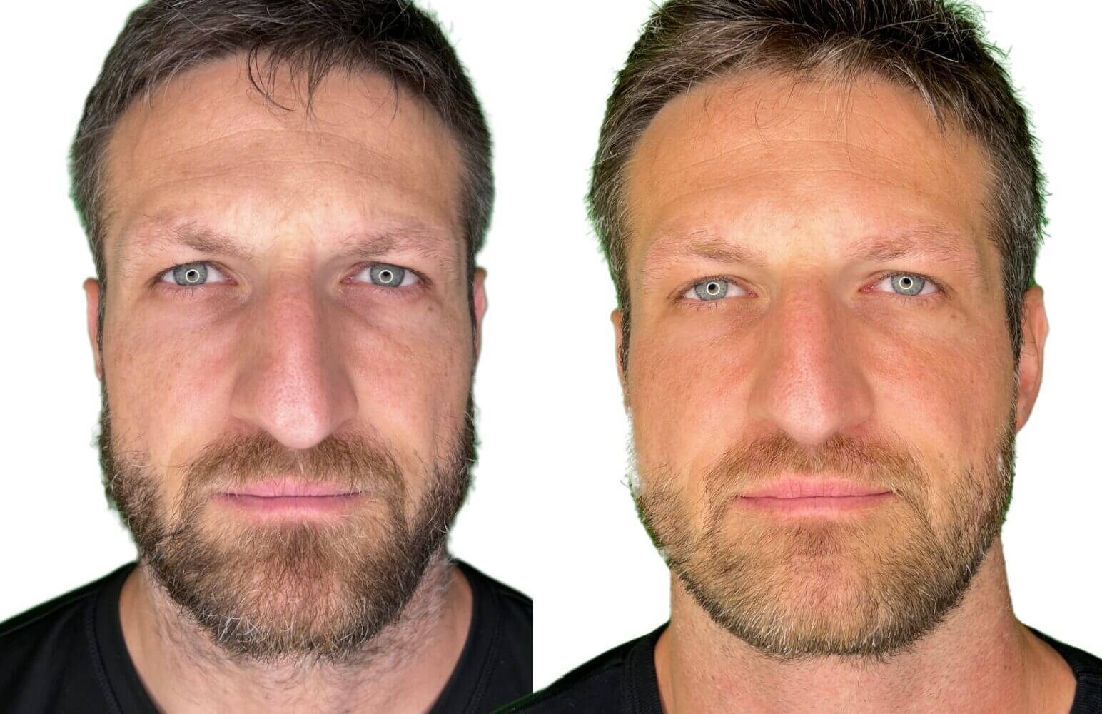 Before (left) and after (right) having used OneSkin for five weeks.