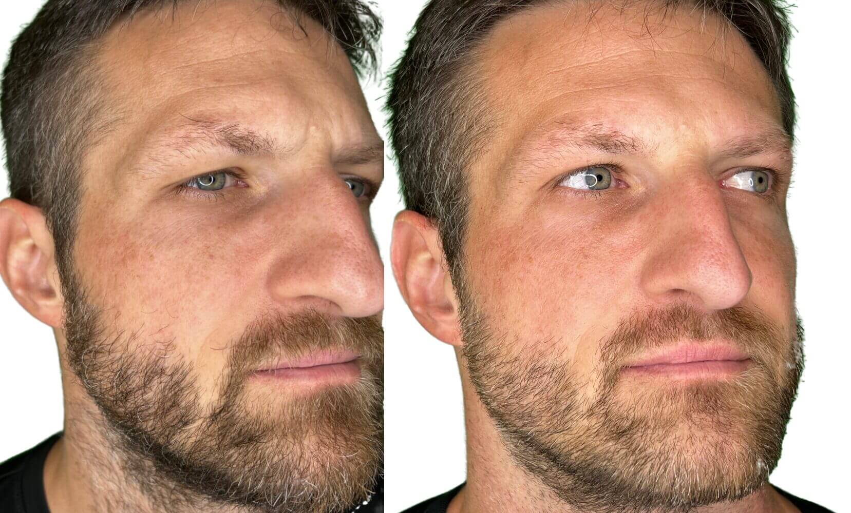 The image shows a reduction of the dark age spots on my check after having used OneSkin on and off for 15 weeks. 