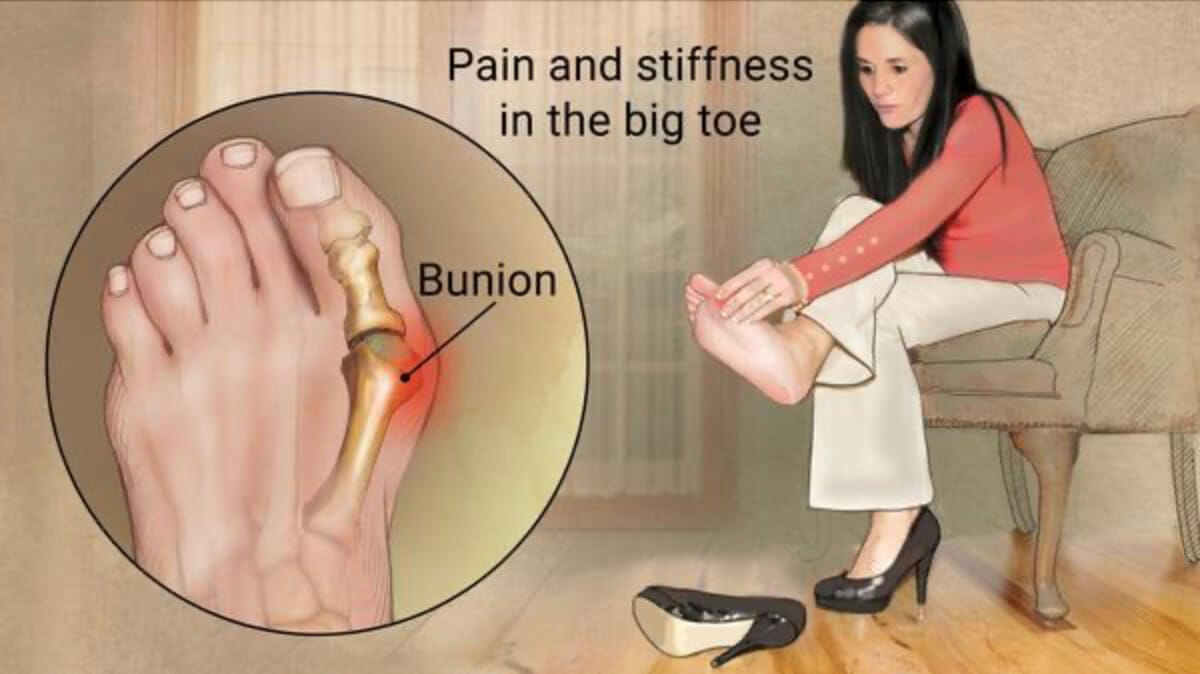 Bunions are not only ugly, they're also signs of poor foot health.