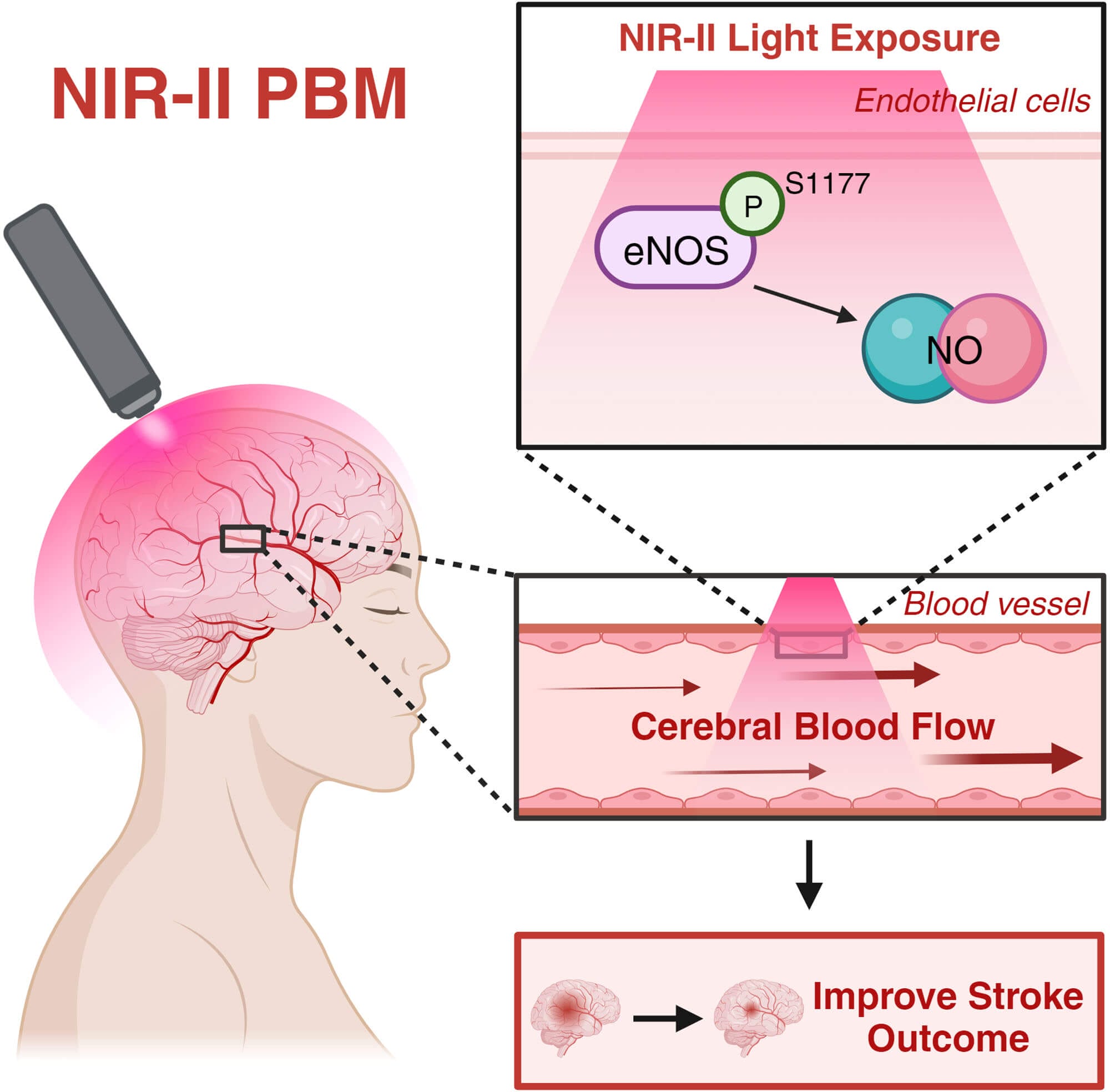 Red light therapy can improve stroke outcomes.